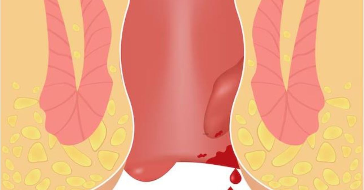 When Sitting Hurts: Modern Care That Brings Lasting Piles Relief 