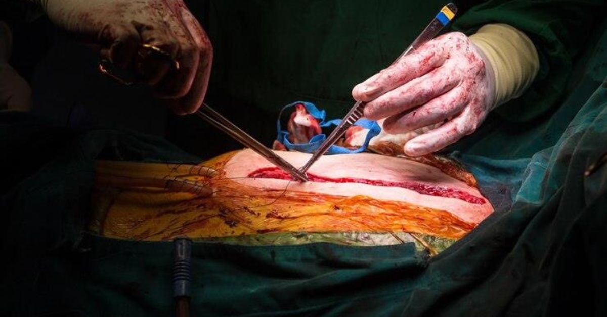 Relief That Stays: Expert Surgical Care for Hernia Recovery 