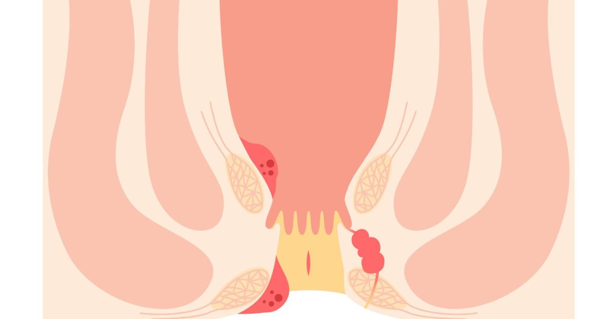 Burning or Itching During Bowel Movements? Get Checked Early for Relief