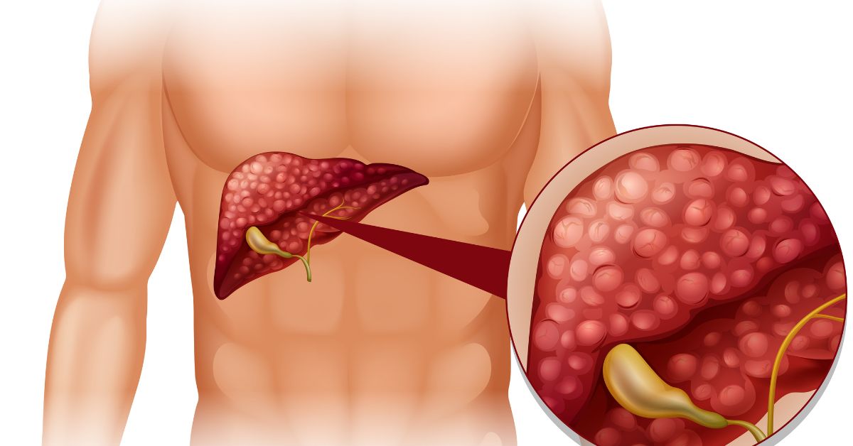 Can Gallstones Be Removed Without Big Cuts Indore? 