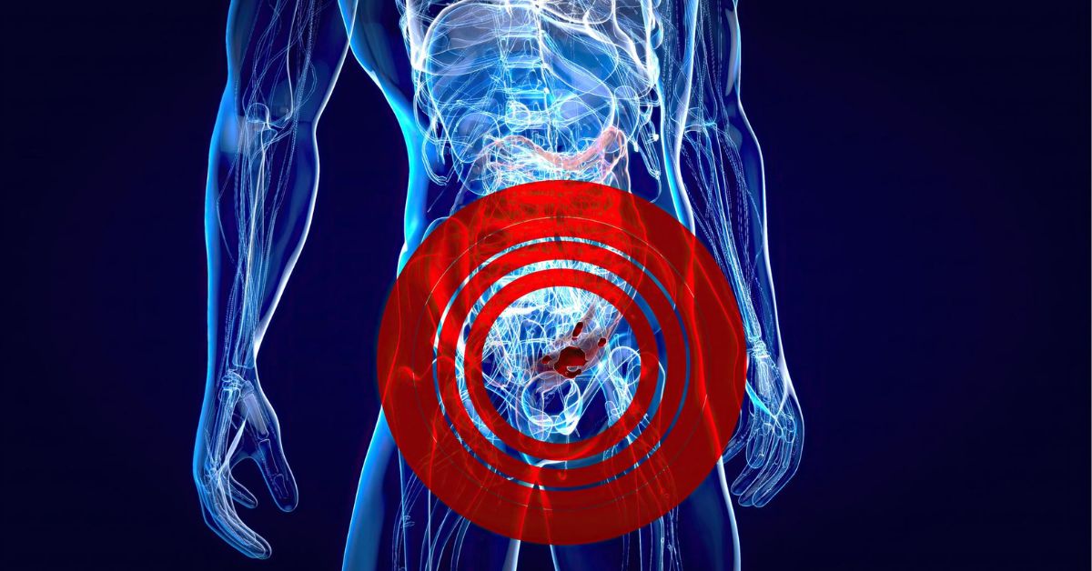 Fissure Treatment in Indore: Symptoms, Causes aur Laser Surgery